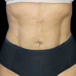 Liposuction Abdomen Before & After Patient #2801