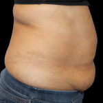 Liposuction Abdomen Before & After Patient #2801