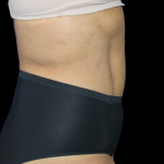Liposuction Abdomen Before & After Patient #2801