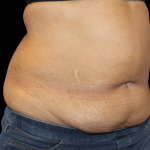 Liposuction Abdomen Before & After Patient #2801