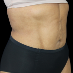 Liposuction Abdomen Before & After Patient #2801