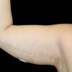 Liposuction to Arms Before & After Patient #2804