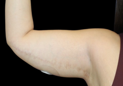 Liposuction to Arms Before & After Patient #2804