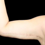 Liposuction to Arms Before & After Patient #2804