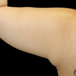 Liposuction to Arms Before & After Patient #2804