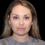 Neck Liposuction Before & After Patient #2816