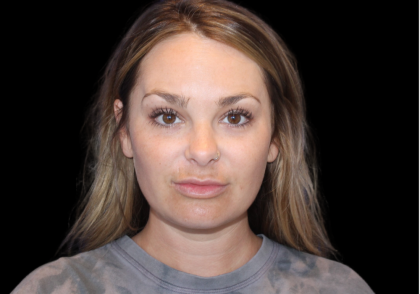 Neck Liposuction Before & After Patient #2816