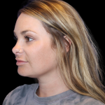 Neck Liposuction Before & After Patient #2816