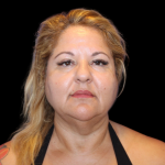 Neck Liposuction Before & After Patient #2826
