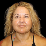 Neck Liposuction Before & After Patient #2826