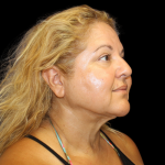 Neck Liposuction Before & After Patient #2826