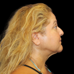 Neck Liposuction Before & After Patient #2826