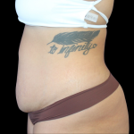 Liposuction Abdomen Before & After Patient #874