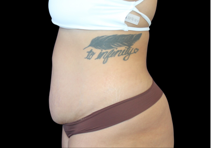 Liposuction Abdomen Before & After Patient #874