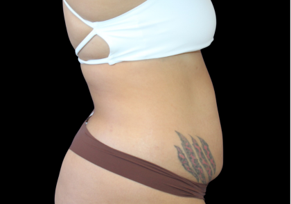 Liposuction Abdomen Before & After Patient #874