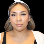 Neck Liposuction Before & After Patient #2815