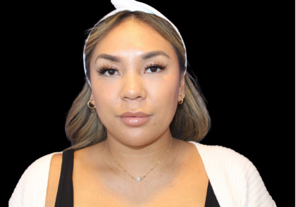 Neck Liposuction Before & After Patient #2815