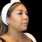 Neck Liposuction Before & After Patient #2815