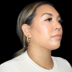 Neck Liposuction Before & After Patient #2815