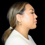 Neck Liposuction Before & After Patient #2815