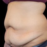 Tummy Tuck Before & After Patient #2499