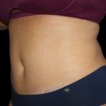 Tummy Tuck Before & After Patient #2499