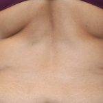 Tummy Tuck Before & After Patient #2499