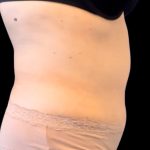 Tummy Tuck Before & After Patient #2497
