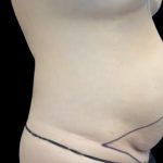 Tummy Tuck Before & After Patient #2497