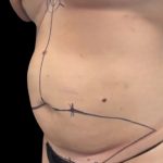 Tummy Tuck Before & After Patient #2497