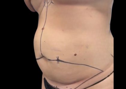 Tummy Tuck Before & After Patient #2497