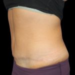 Tummy Tuck Before & After Patient #2498