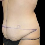 Tummy Tuck Before & After Patient #2498