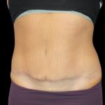 Tummy Tuck Before & After Patient #2498